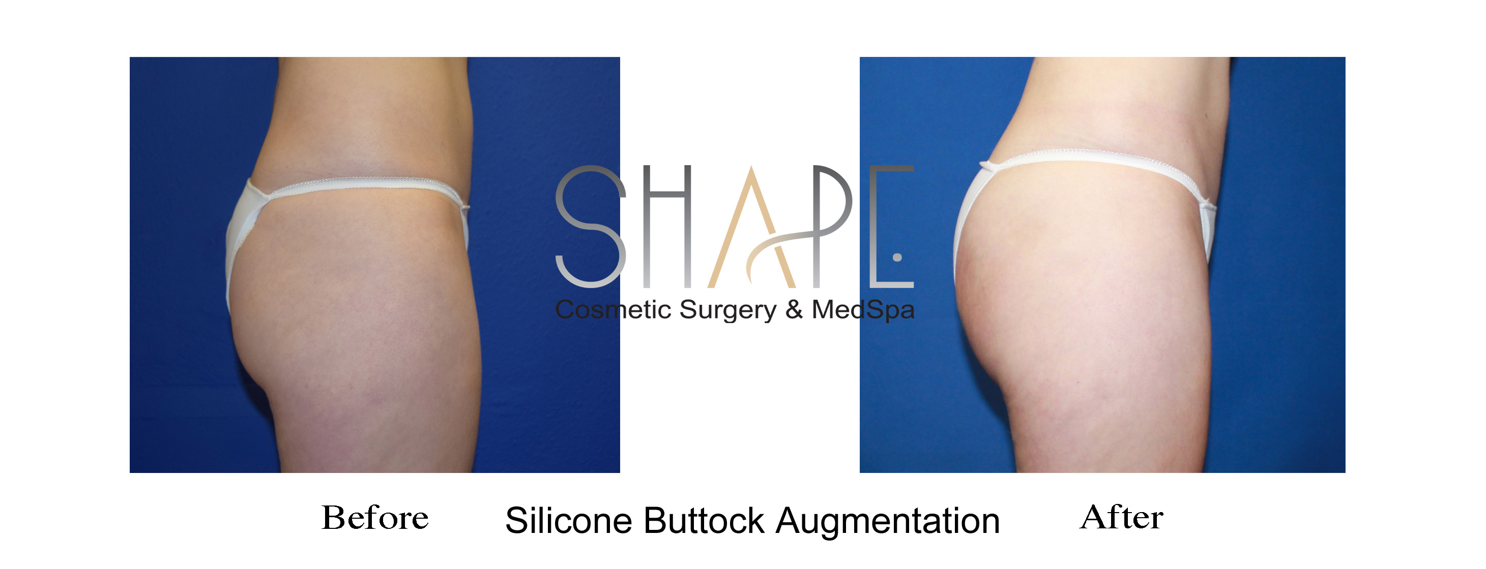 Buttock Augmentation - Tri-Cities - Kennewick, Pasco, and Richland