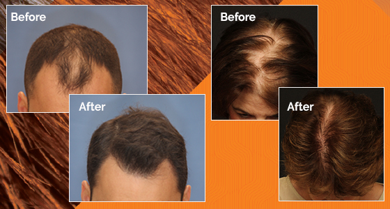 NeoGraft Hair Restoration - Tri-Cities - Kennewick, Pasco, and Richland |  Plastic Surgery