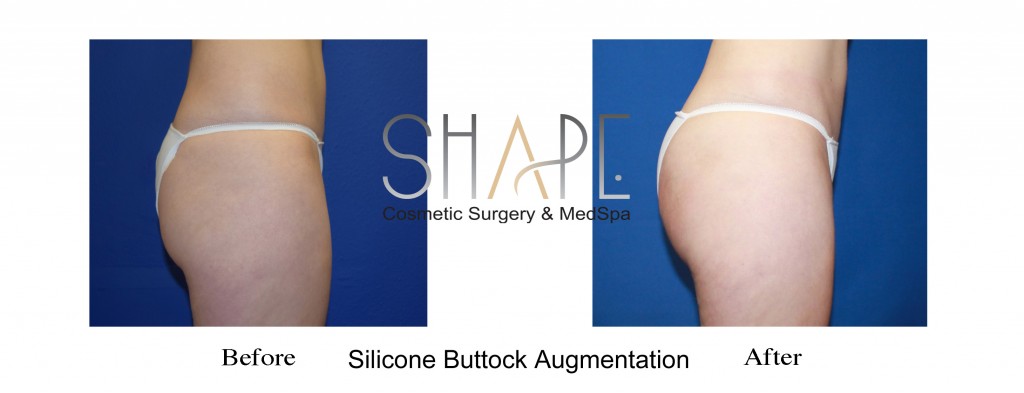 buttock augmentation plastic surgery